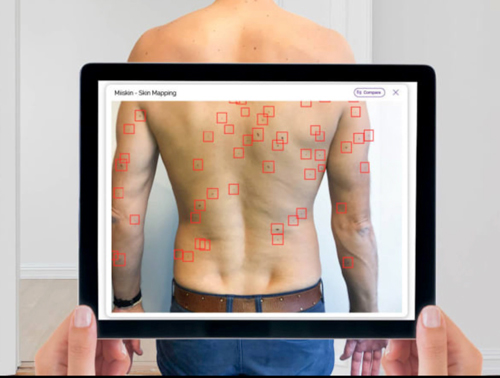 New App Scans Moles - Cancer Watch